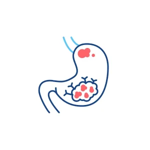 Gastric Cancer
