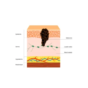 Melanoma