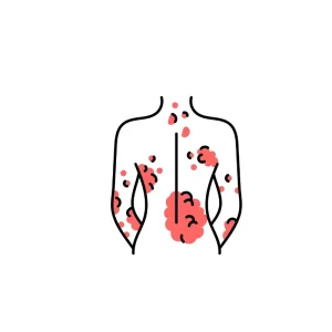 Plaque Psoriasis