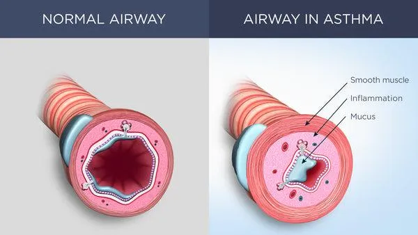 Asthma