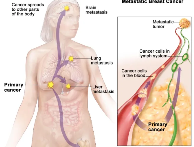 HER2 Positive Metastatic Breast Cancer
