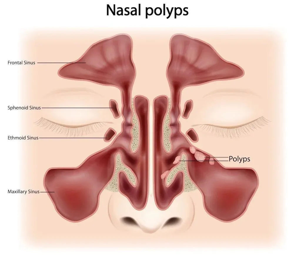Nasal Polyps (CRSwNP)