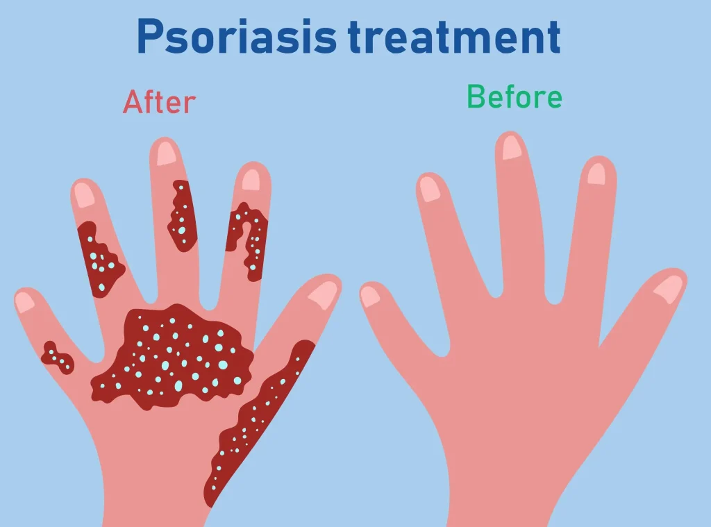 Psoriasis Treatment