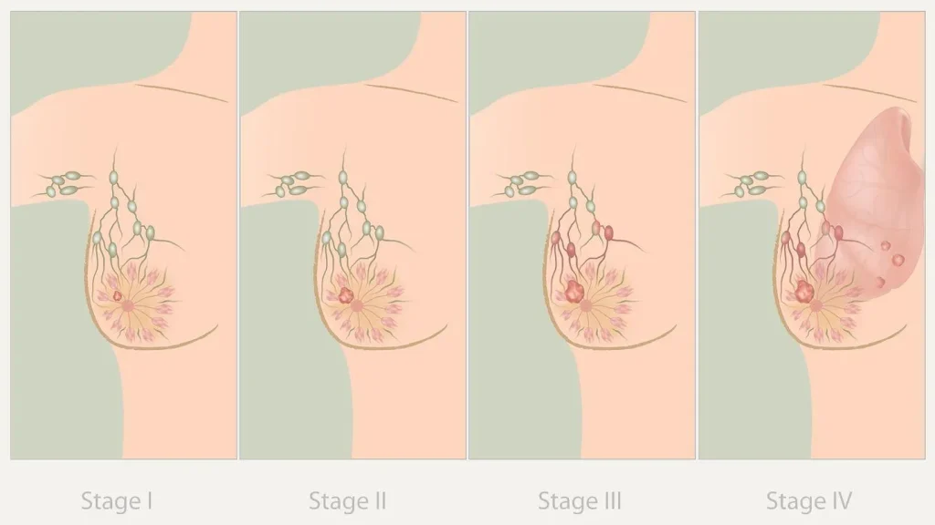 Stage of Breast Cancer